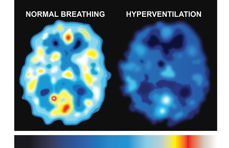 SPECT scan comparing brain metabolism before and during overbreathing, with darker regions showing reduced metabolism